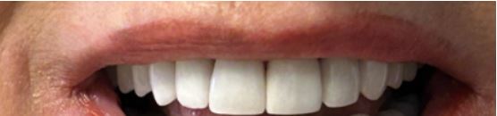 Actual Patient Veneers