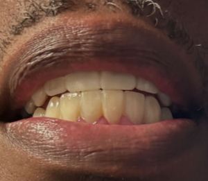 Houston patient with permanent veneers