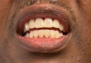 Houston patient with temporary veneers