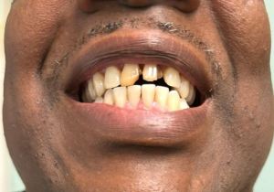 Houston patient before veneers